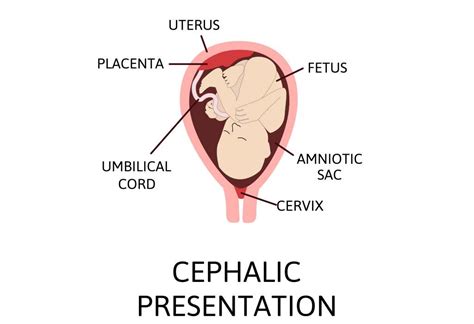 Cephalic Presentation of Baby During Pregnancy