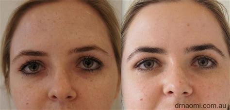 Freckle Removal Face FAQs - Best Clinic Sydney for Dermal Fillers