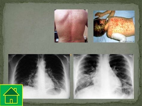 Mycoplasma pneumonia