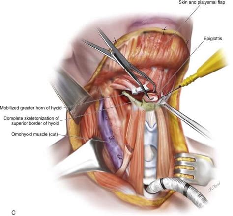 Laryngectomy procedure. The cosmetic surgeon starts the… | by Labex ...