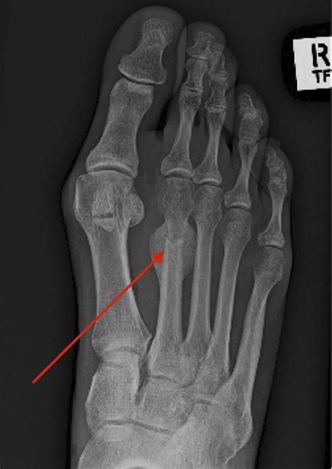 Physical therapy for 5th metatarsal fracture - sheryonweb