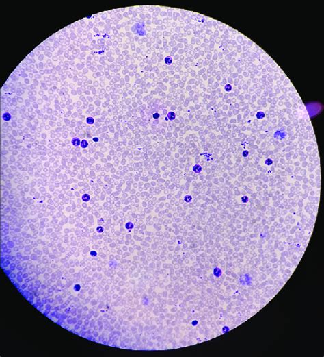 Peripheral blood smear (×100; oil immersion) showing normocytic ...