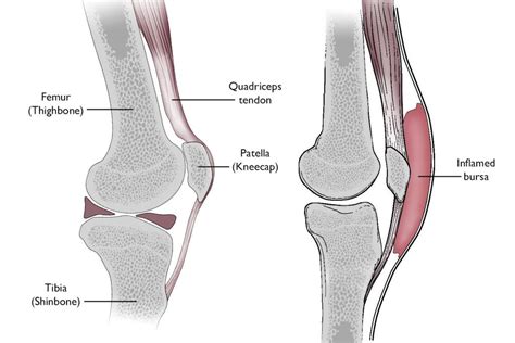 Prepatellar Bursitis - Sports Medicine Review