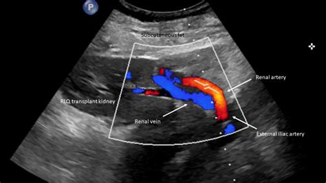 Doppler Renal Assessment, Protocols, and Interpretation - StatPearls - NCBI Bookshelf