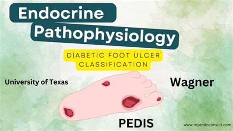 Diabetic Foot Ulcer Stages – A Concise Guide – My Endo Consult