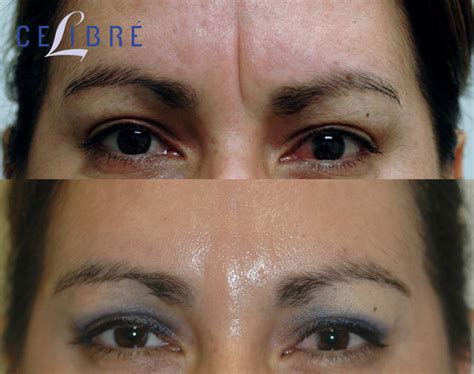 Botox Before and After Pictures: Real Results from Real Patients