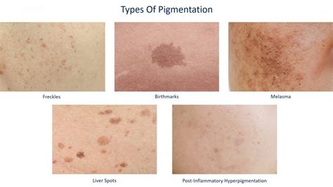 Get Rid Of Hyperpigmentation With Home Remedies | Dream Plastic Surgery