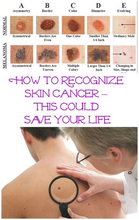 How To Recognize Skin Cancer This Could Save Your Life | Health tips, Skin cancer awareness ...