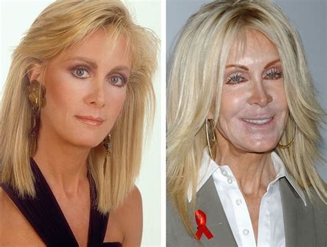 Joan Van Ark Before and After Plastic Surgery: Boob, Nose, Face