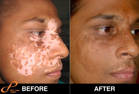 White Patches or Vitiligo is Common, But After Sometimes it Make Part ...