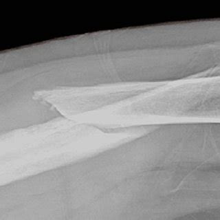 Femur x-ray showing the distal displaced femoral fracture (view 1) | Download Scientific Diagram