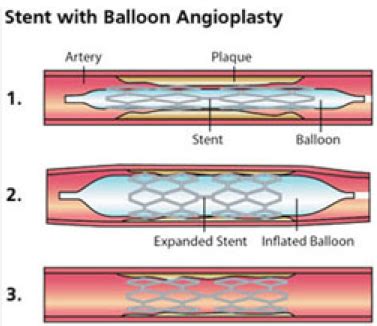 Balloon Angioplasty & Stenting - Vascular Care Centre