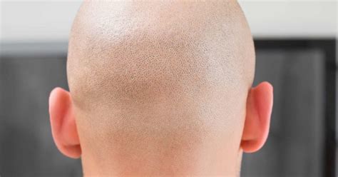 Alopecia totalis: Symptoms, treatments, and types