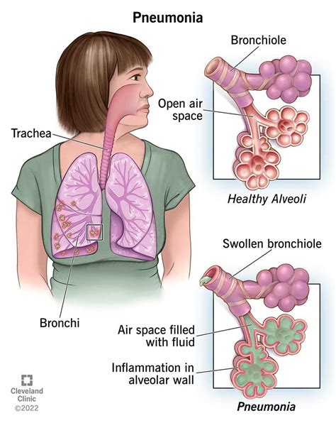 Pneumonia: Causes, Symptoms, Diagnosis & Treatment