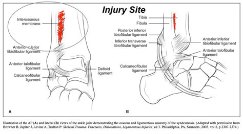 High vs. Low Ankle Sprains - What's the difference?