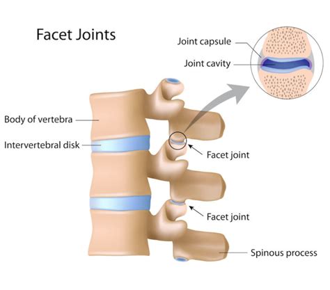 Facet Hypertrophy Symptoms, Diagnosis, Treatment | AllSpine