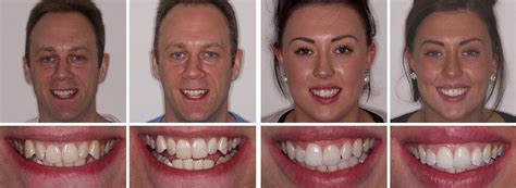 Can You Remove Bonding From Teeth - TeethWalls