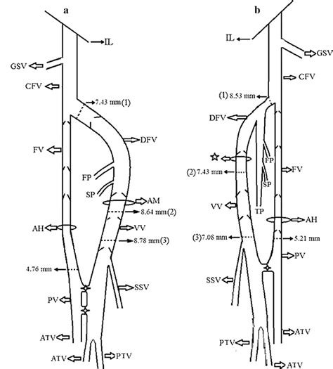 Schematic view of the venous course, valves and diameters of the veins ...