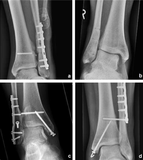 [PDF] Complications of Syndesmotic Screw Removal | Semantic Scholar