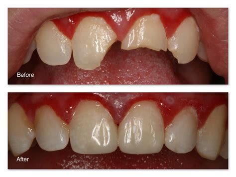 Tooth Colored Fillings Gallery – Dr. Jack M. Hosner, D.D.S.