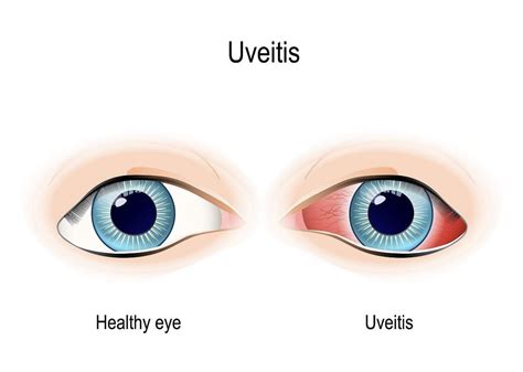 Uveitis Overview | Fort Lauderdale Eye Institute