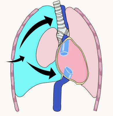 Adult Emergency Medicine: Tension Pneumothorax