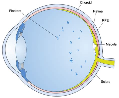 Eye Floater Prevention, Symptoms & News