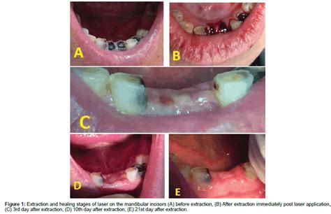 Evaluation of Coagulation and Healing Effect of Laser and Hemostatic Sponge on Post Extraction ...