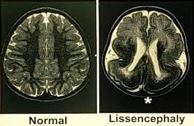 Medical Treatment Pictures-for Better Understanding: Lissencephaly