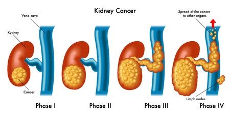 Kidney Cancer - Treatment in Israel | D.R.A Medical