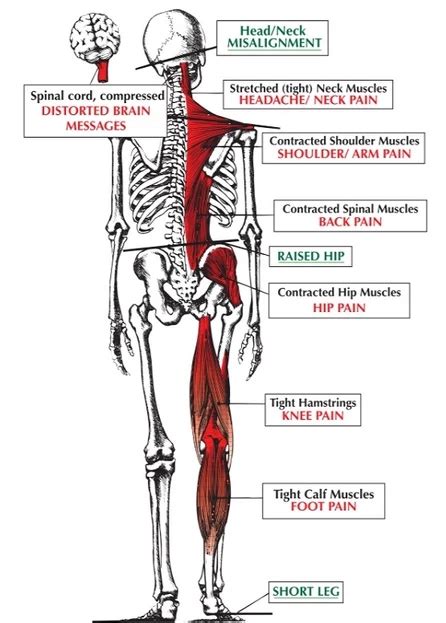 Do You Feel Twisted? Lopsided? Uneven in the Hips? - Ripple Chiropractic