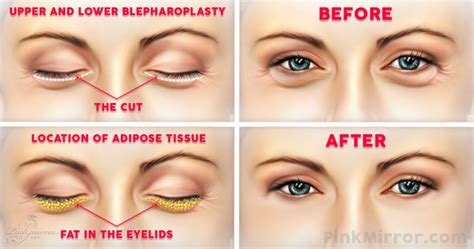 Surgery-under-eye-bags-Blepharoplasty-eyelid-lift – PinkMirror Blog