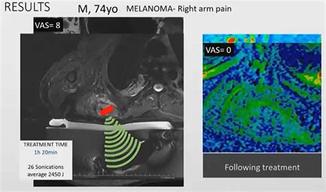 MRI-guided focused ultrasound can help with pain for cancer patients