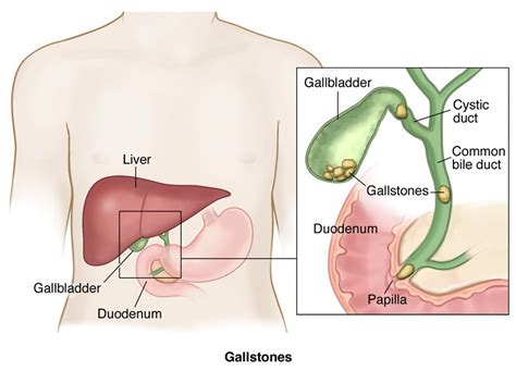 Bile Duct Stones Symptoms, Treatments Dallas TX - Kedia