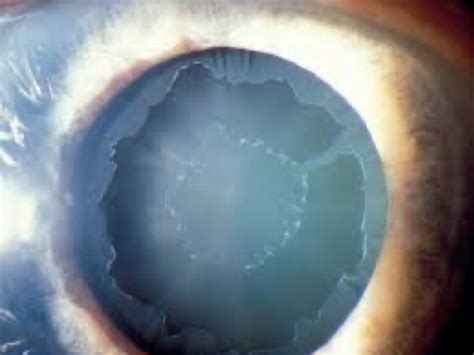 Pseudoexfoliation Glaucoma - Tahmina Pearsall