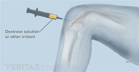 Can Cortisone Injection Help Knee Pain - Stéroïde Légale