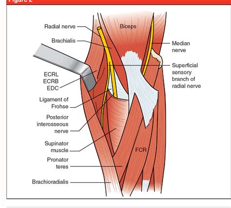 Figure 2 from Ulnar Tunnel Syndrome, Radial Tunnel Syndrome, Anterior Interosseous Nerve ...