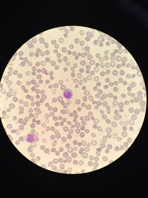 Hereditary Spherocytosis Causes Symptoms Treatment