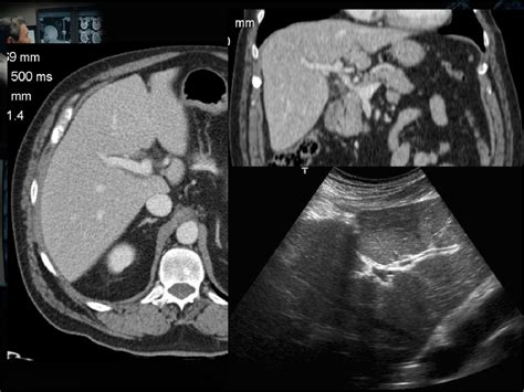 Ultrasound periportal cuffing: differential diagnosis | Semantic Scholar