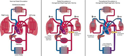 Congenital Diaphragmatic Hernia Ultrasound