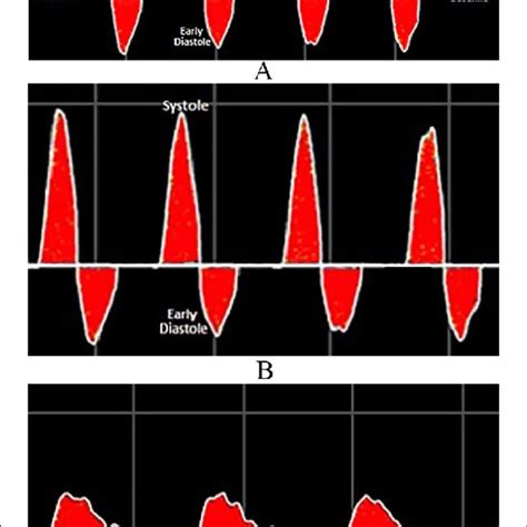 Triphasic (A), biphasic (B), and monophasic (C) Doppler waveforms ...