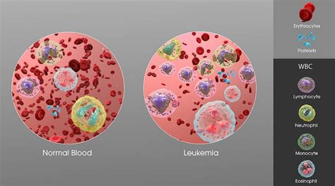 The Future of Leukemia Treatment: How Base-Edited T-Cells are Making a Difference - Gilmore ...