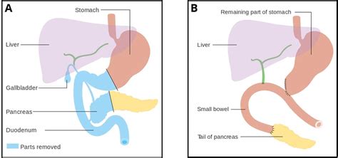 Pancreatic Cancer - Clinical Features - Management - TeachMeSurgery