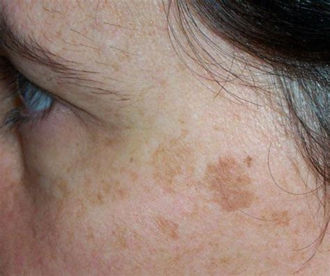 cancerous freckles - pictures, photos