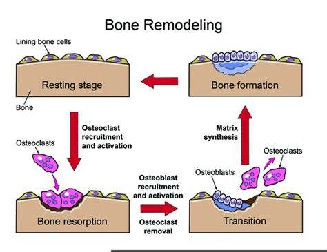 Bone Remodeling | Free Images at Clker.com - vector clip art online, royalty free & public domain