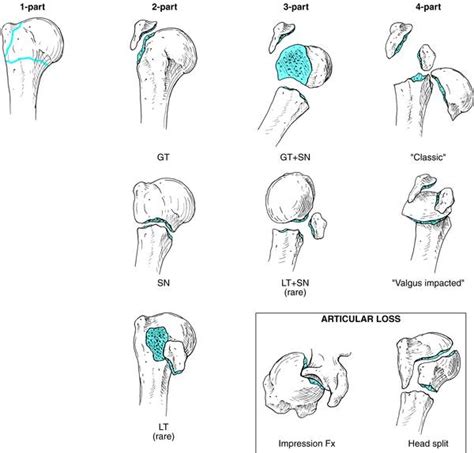 Proximal Humerus Fractures | Bone and Spine