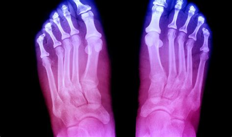 Arthritis pain: Foot pain could be reactive infection condition - This Morning's Dr Ranj ...