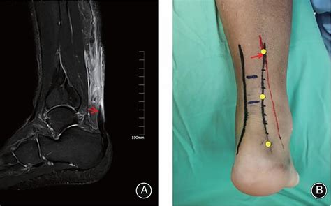 A New Technique of Achilles Tendon Rupture Repaired by Double Transverse Mini‐incision to Avoid ...