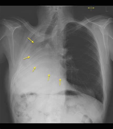 Pneumonectomy with compensatory hyperinflation - Radiology at St ...