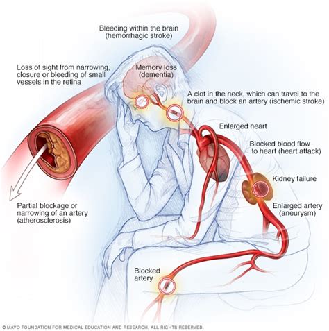 High blood pressure dangers: Hypertension's effects on your body - Mayo Clinic